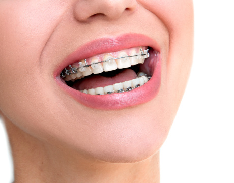 Ceramic self-ligating braces