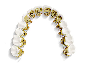Incognito lingual braces