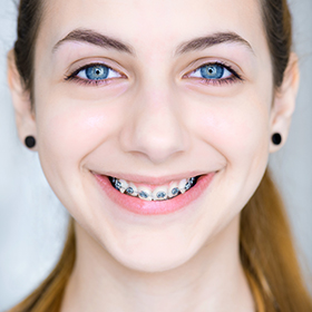 Metal braces