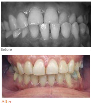 Crossbite treatment result