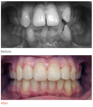 Crowding treatment result