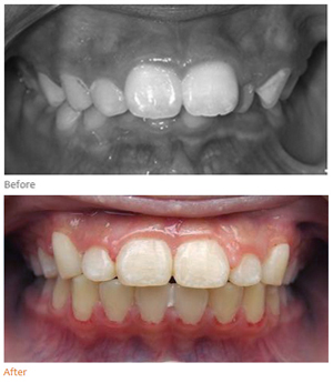 Overbite treatment result