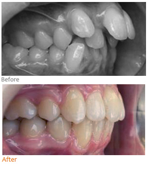Overjet treatment result
