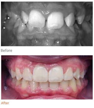 Spacing treatment result